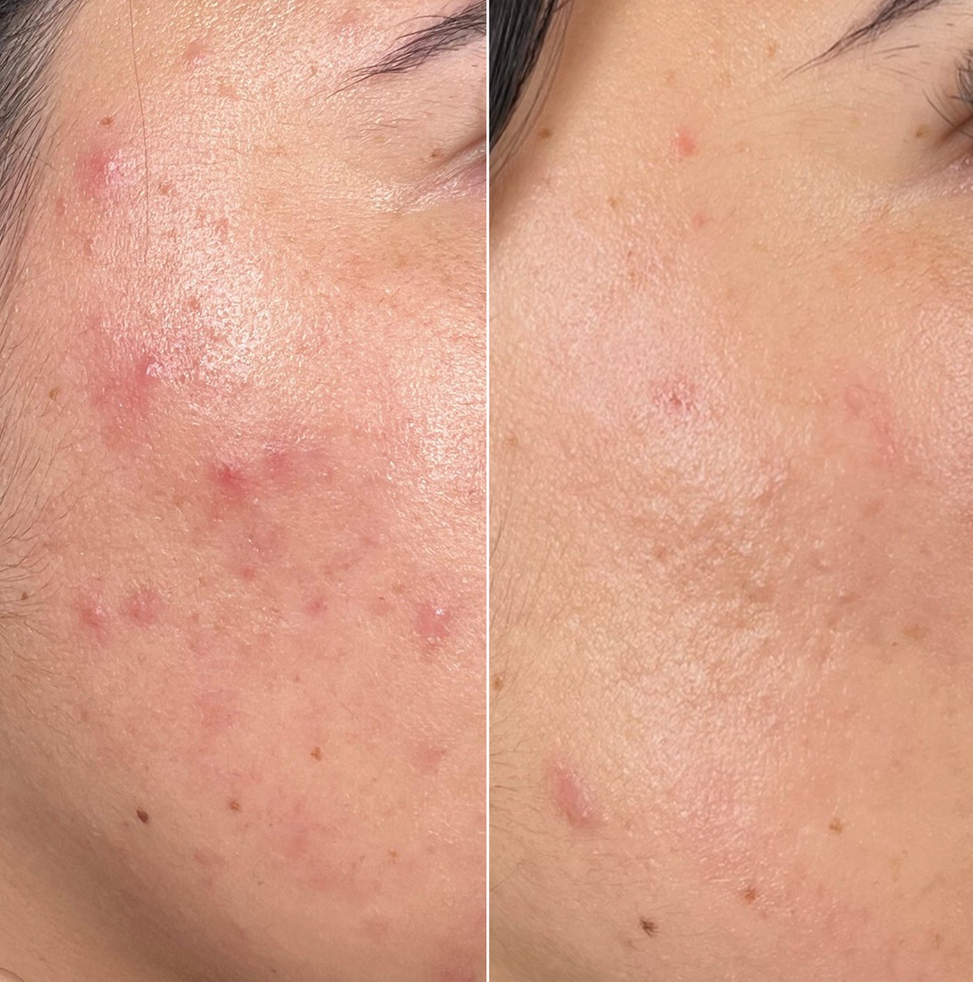 HydraFacial before and after — Case 01 · Clarifying course
