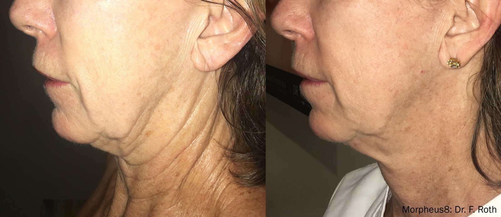 Morpheus8 before and after — Case 01 · Jawline & neck